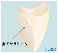 オールセラミック・クラウン